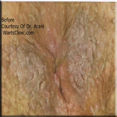 anal warts left untreated